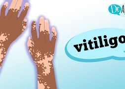 vitiligo