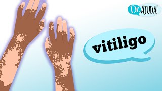 Vitiligo: o que é vitiligo e quando suspeitar