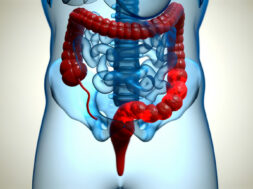 Câncer: Rastreamento para câncer colorretal pode ser implementado no SUS