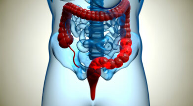 Câncer: Rastreamento para câncer colorretal pode ser implementado no SUS